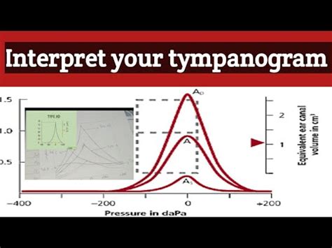 how to read a tympanogram|How to interpret a tympanogram .